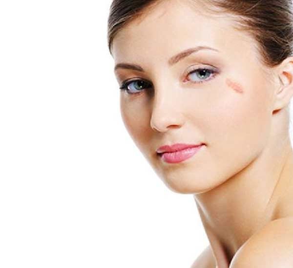 Dubai Clinics Offering Custom Birthmark Removal Treatments